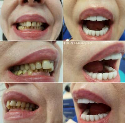 Керамических реставрация на всю группу зубов