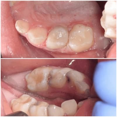 Инвазивная герметизация фиссур в стоматологии