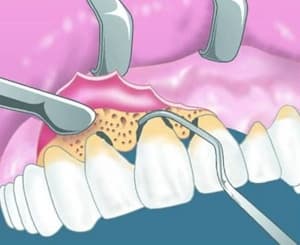Лечение пародонта в стоматологии АССА