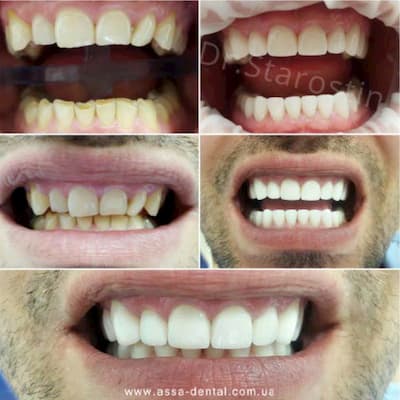 Поднятие прикуса на 5 мм, восстановление всех групп зубов 
