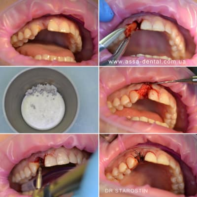 Перелом корня зуба 