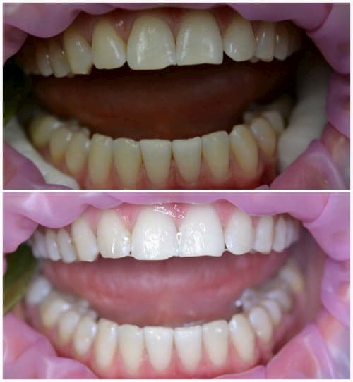 Отбеливание зубов 1