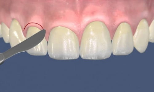 Пластика десны стоматология асса