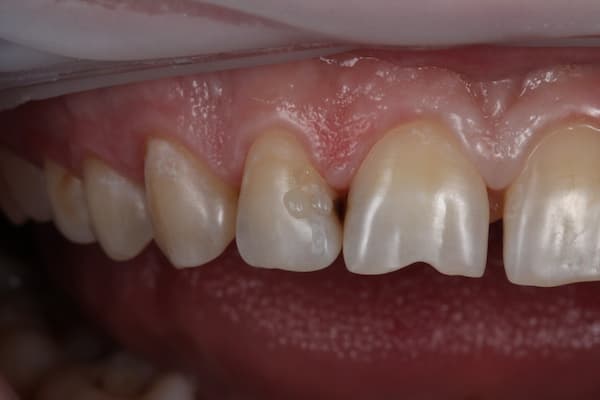 Восстановление зубов после лечения