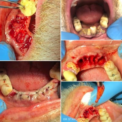 Удаление разрушенных 8 корней зубов