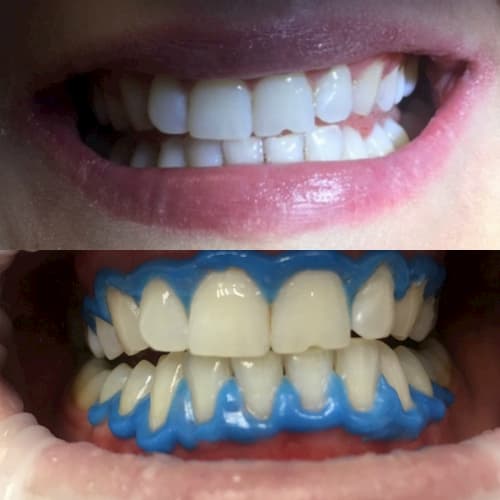 Отбеливание зубов 4
